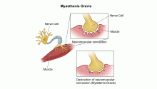 Miastenija gravis